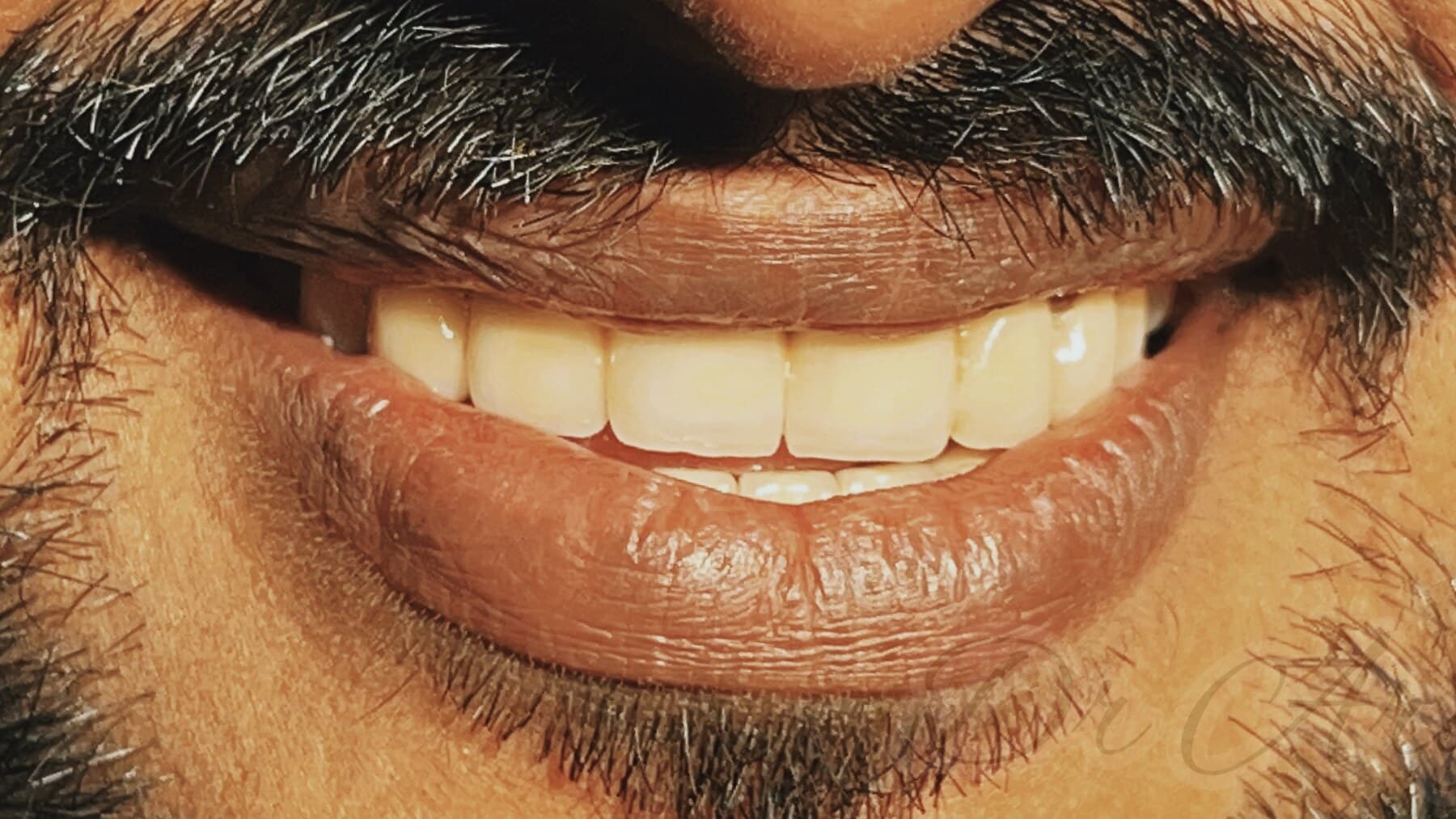 Smile Correction with Crown — before treatment